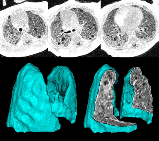 High-resolution 3D ultrashort echo-time MRI.